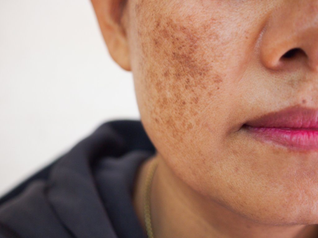 Melasma, What Can You Do About It? - HammBurg