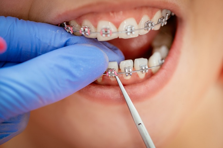 Getting Braces