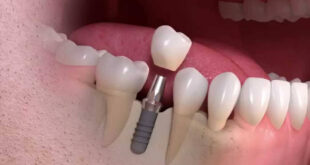 Dental Implants in Mumbai
