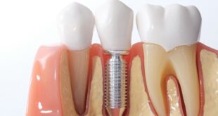 Cover Dental Implants