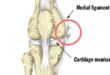 knee pain - MCL SPRAIN