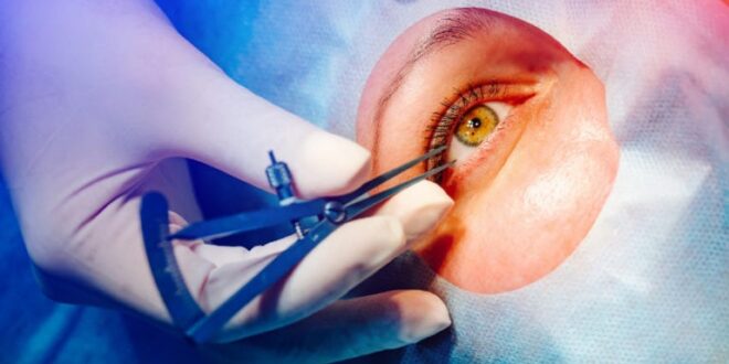 About Cataracts Surgery