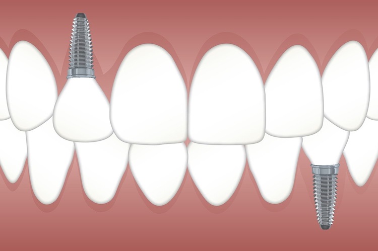 Digital Dental Implants: The Future of Tooth Replacement
