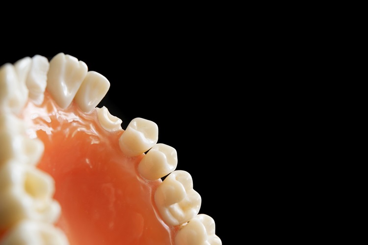 Wisdom Tooth Infections: Signs, Risks and When to Seek Care
