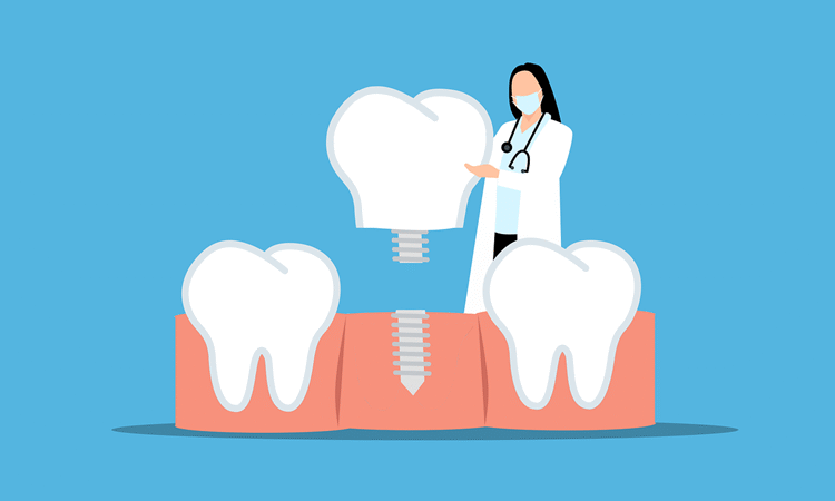 Dental Implants: Why Bone Health Matters