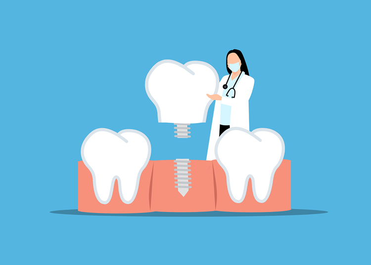 Dental Implants: Why Bone Health Matters